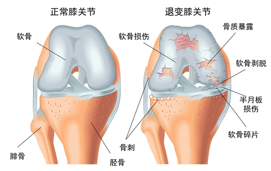 比如髕股關節疼痛綜合徵,髂脛束摩擦綜合徵,髕腱炎,鵝足腱滑囊炎,髕下