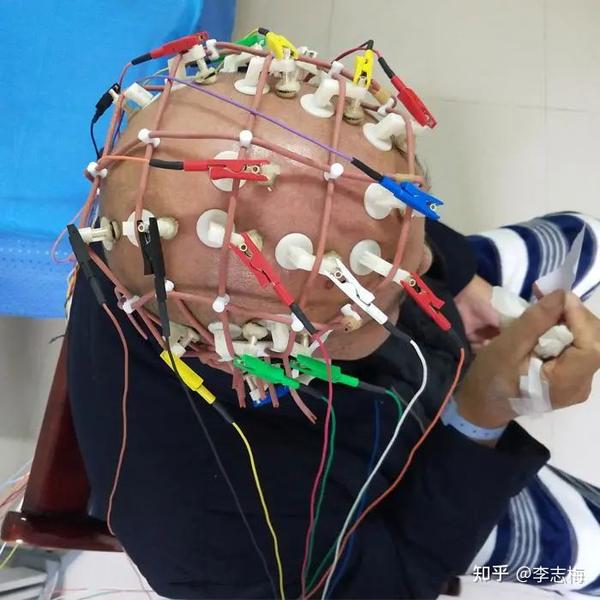 脑电图检查准不准，关键是看这几点 知乎 