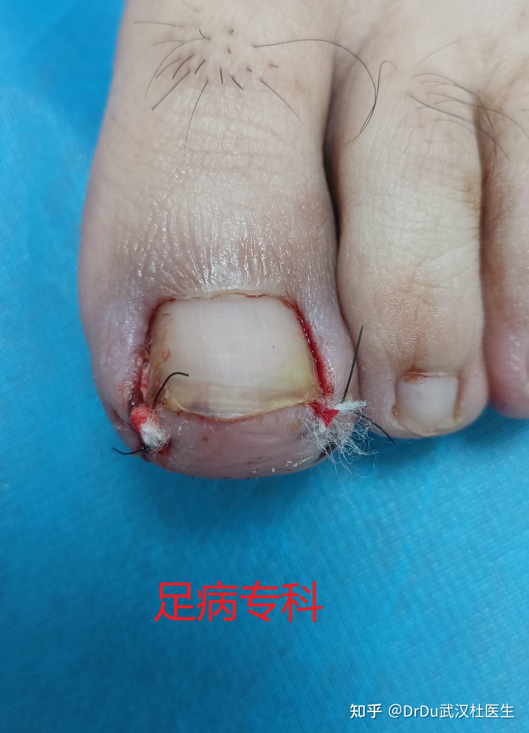 一例双足拇趾甲沟炎的手术病例