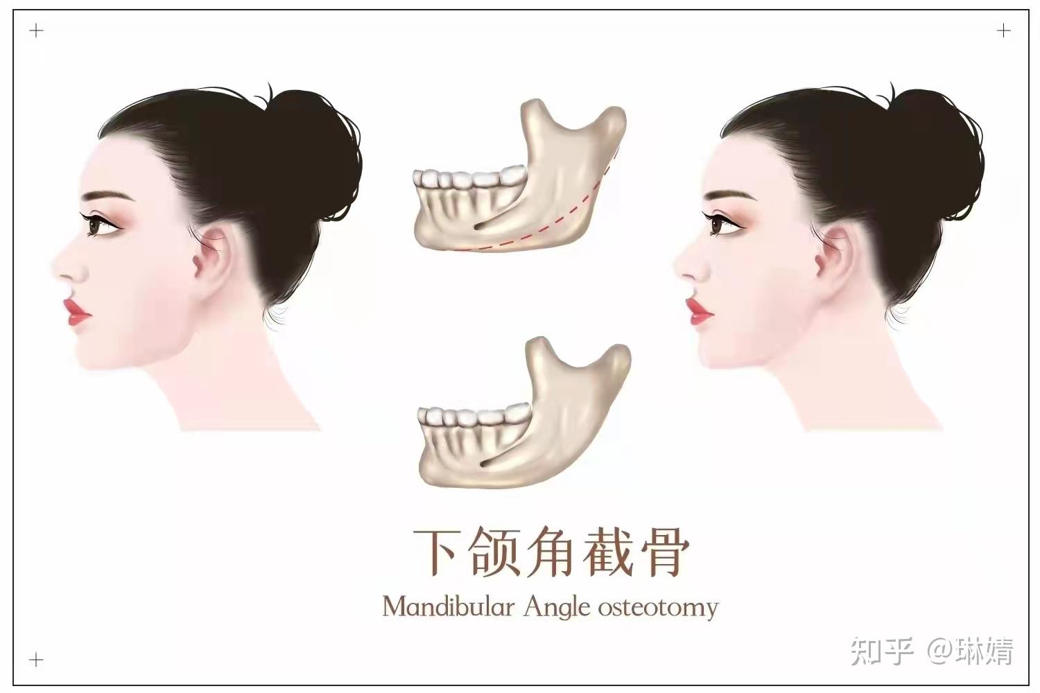 下颚角 zhuanlan.zhihu.com