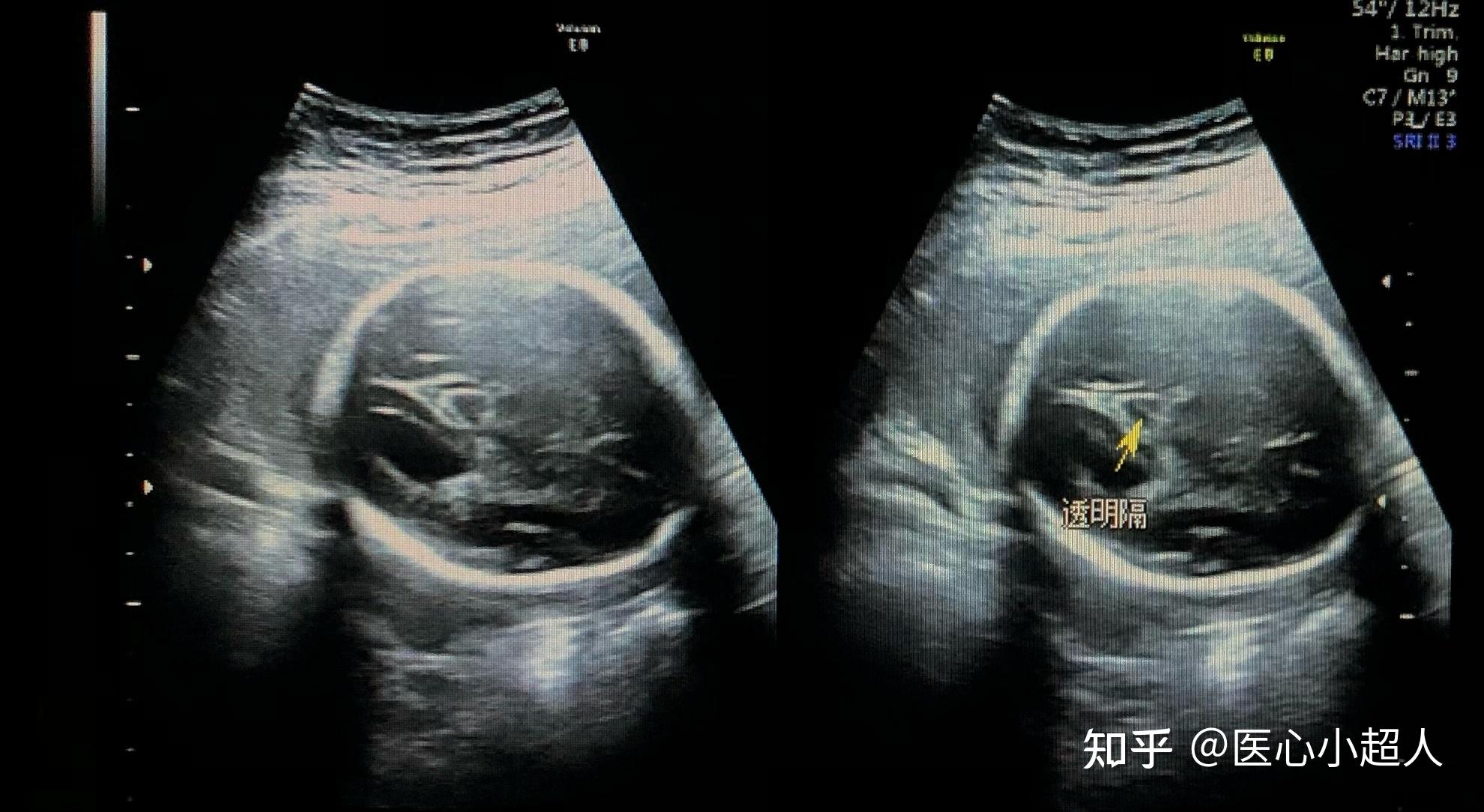 胎儿颅脑的超声所见