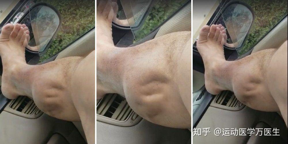 跑步后小腿肚痛,16种病因要鉴别,能不重视吗?