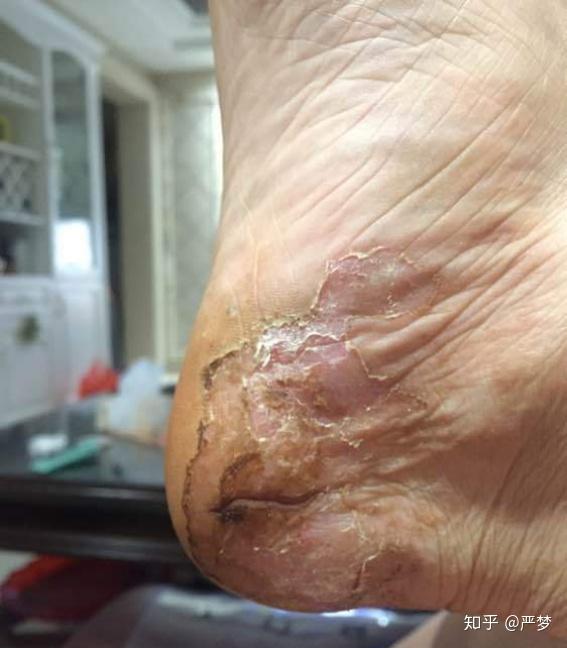 尴不尴尬脚气脚臭一起来看你