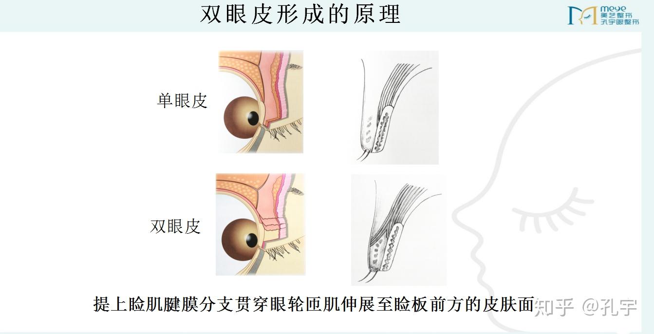 做个双眼皮怎么变成上睑下垂了