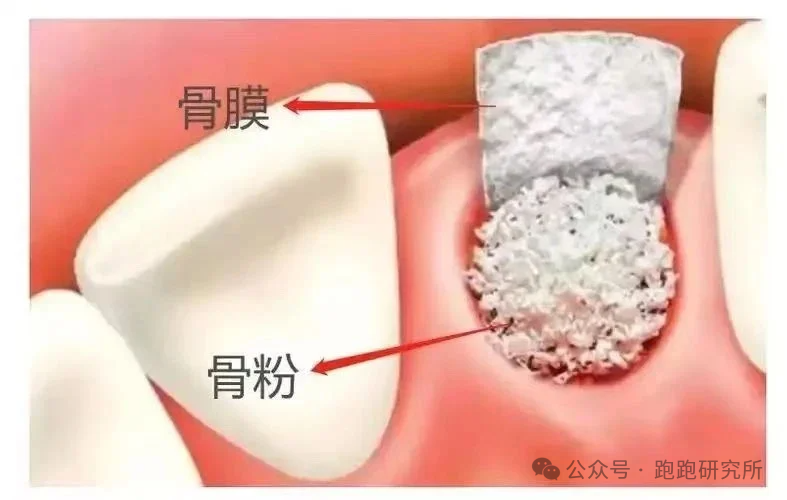 号称“骨量魔术师”的北大口腔林野教授,在高难度种植牙这一块可以说是“一骑绝尘”。 - 知乎