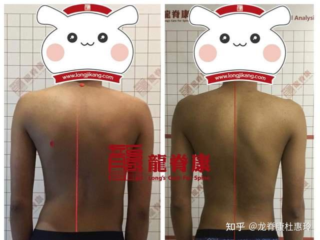 青少年脊柱侧弯、驼背是什么原因导致的? - 知乎