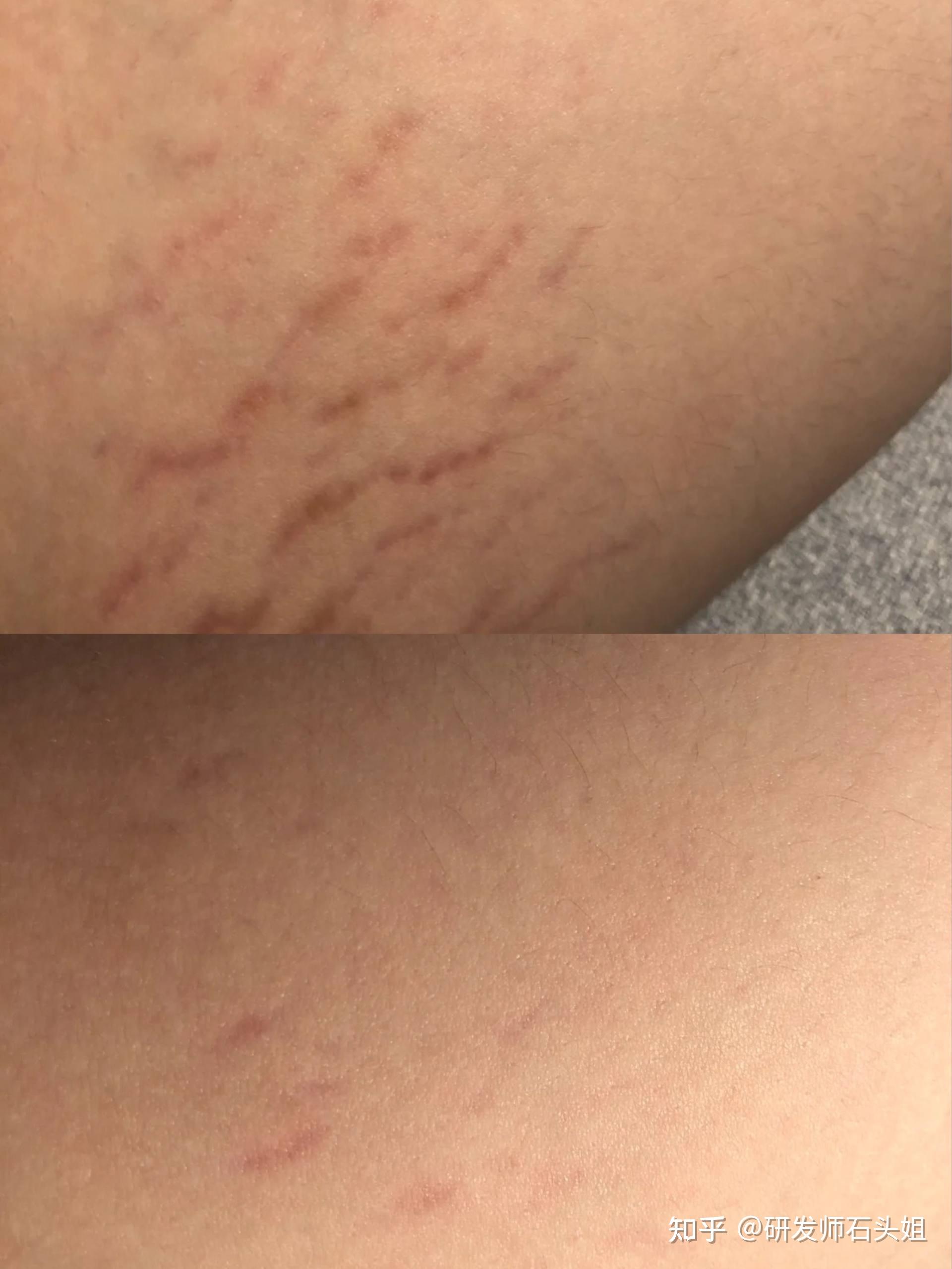 腿上为什么有妊娠纹的原因百科在线 腿上为什么有妊娠纹的原因百科在线