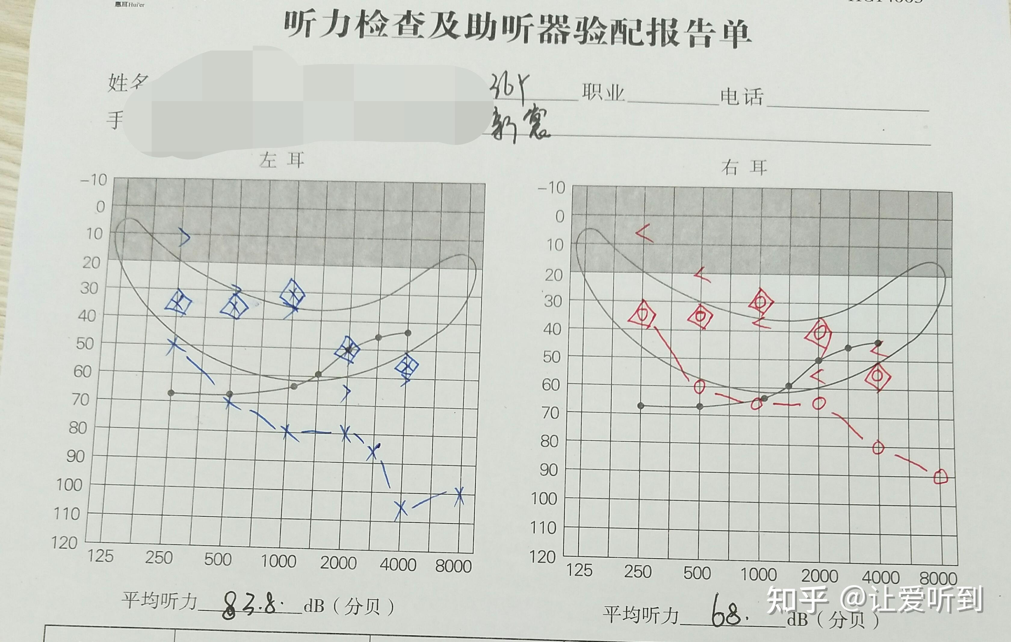 重庆渝北助听器神逸大功率定制机验配案例分享