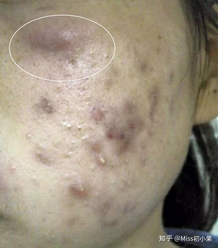 休眠火山痘攻略