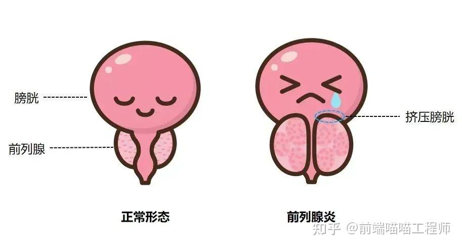 慢性前列腺炎痊愈宝典 - 知乎