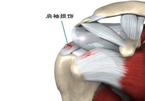 肩峰撞擊綜合徵天津艾柯特運動康復