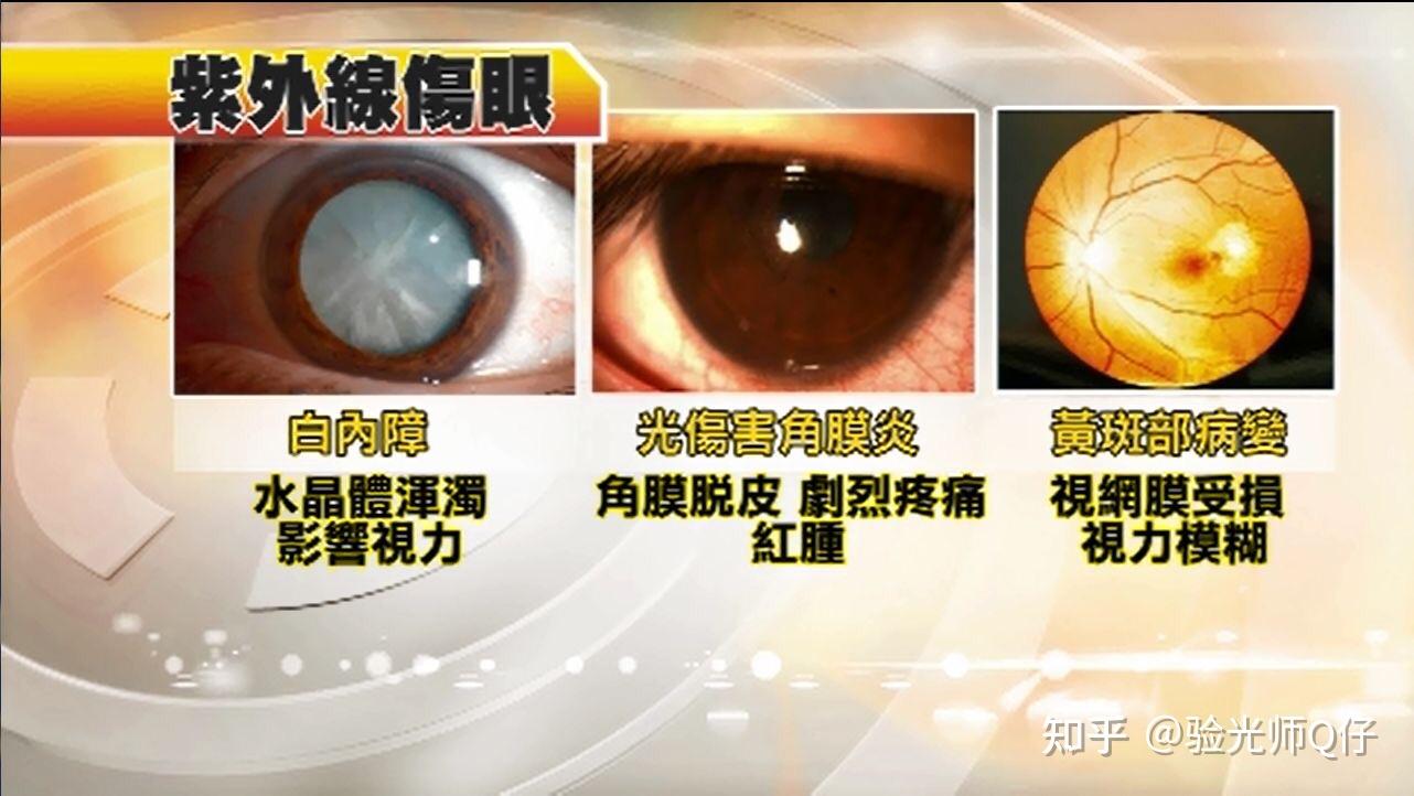 干眼病等眼表损伤,诱发急性角膜炎,雪盲症,电光性眼炎等结膜角膜损伤