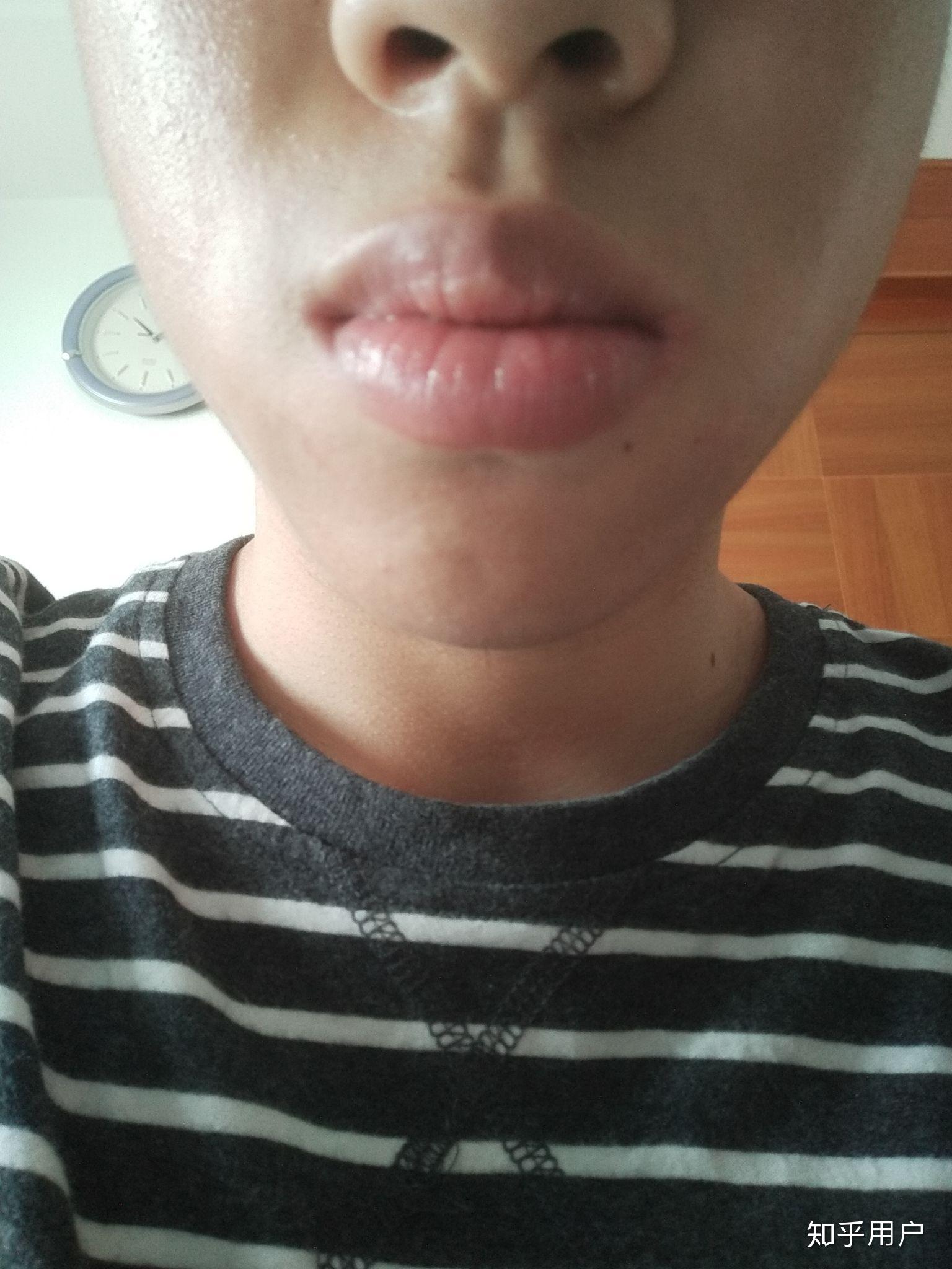 男生嘴唇太厚怎么办