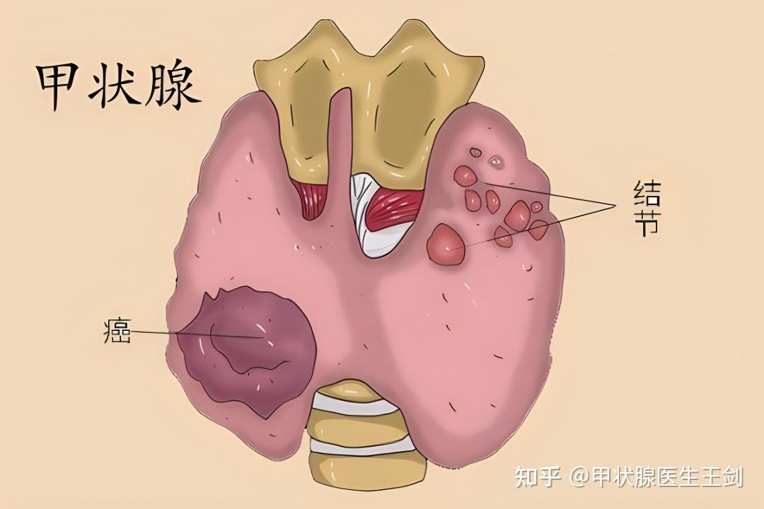 甲状腺瘤的位置图片图片