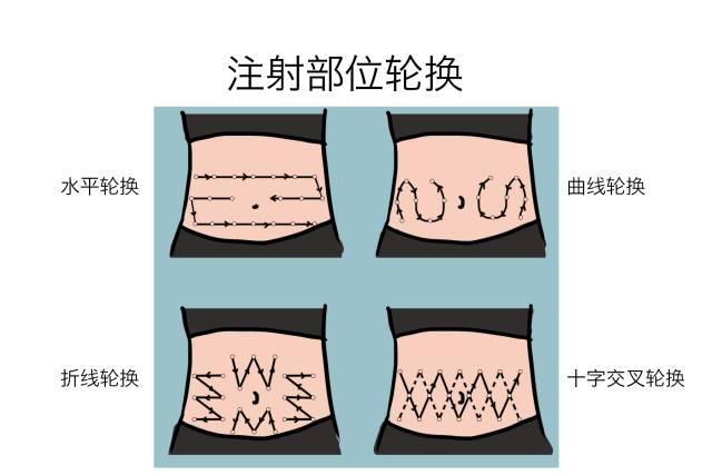 胰岛素部位图轮换图片