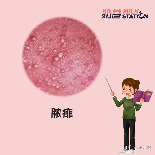 夏季宝宝长痱子了怎么办
