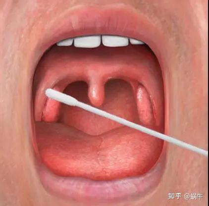 ”）在你嗓子眼儿捅啊捅，那是干嘛，其实那是往下刮你嗓子眼儿的细胞。 这些，我们专业人士都有不同的官方