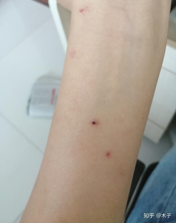 蚊子疤痕 - 知乎
