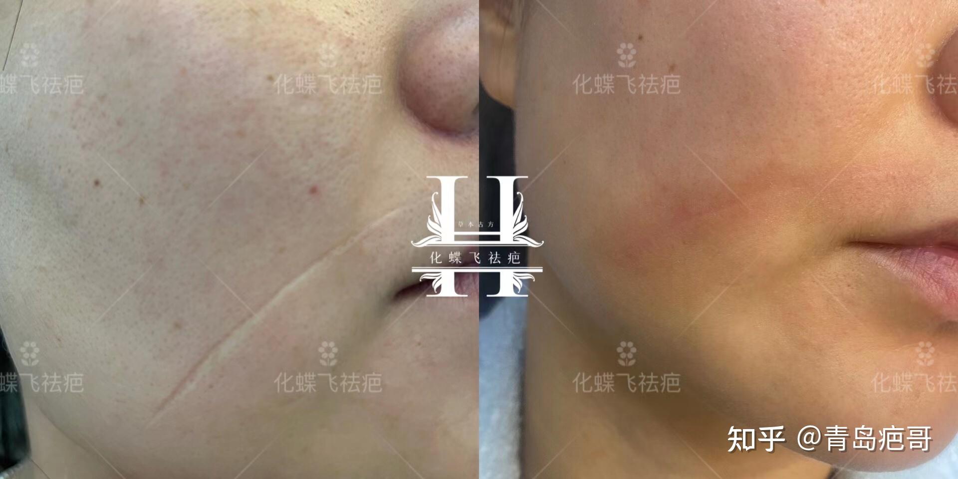 十多年的凹陷疤痕 - 知乎