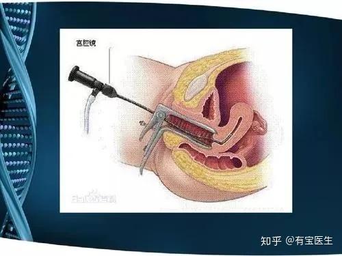 只是宫腔粘连为什么医生做了几次手术
