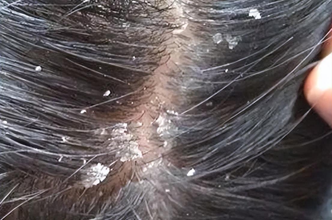 昆明头皮管理:头皮屑到底是怎么形成的 