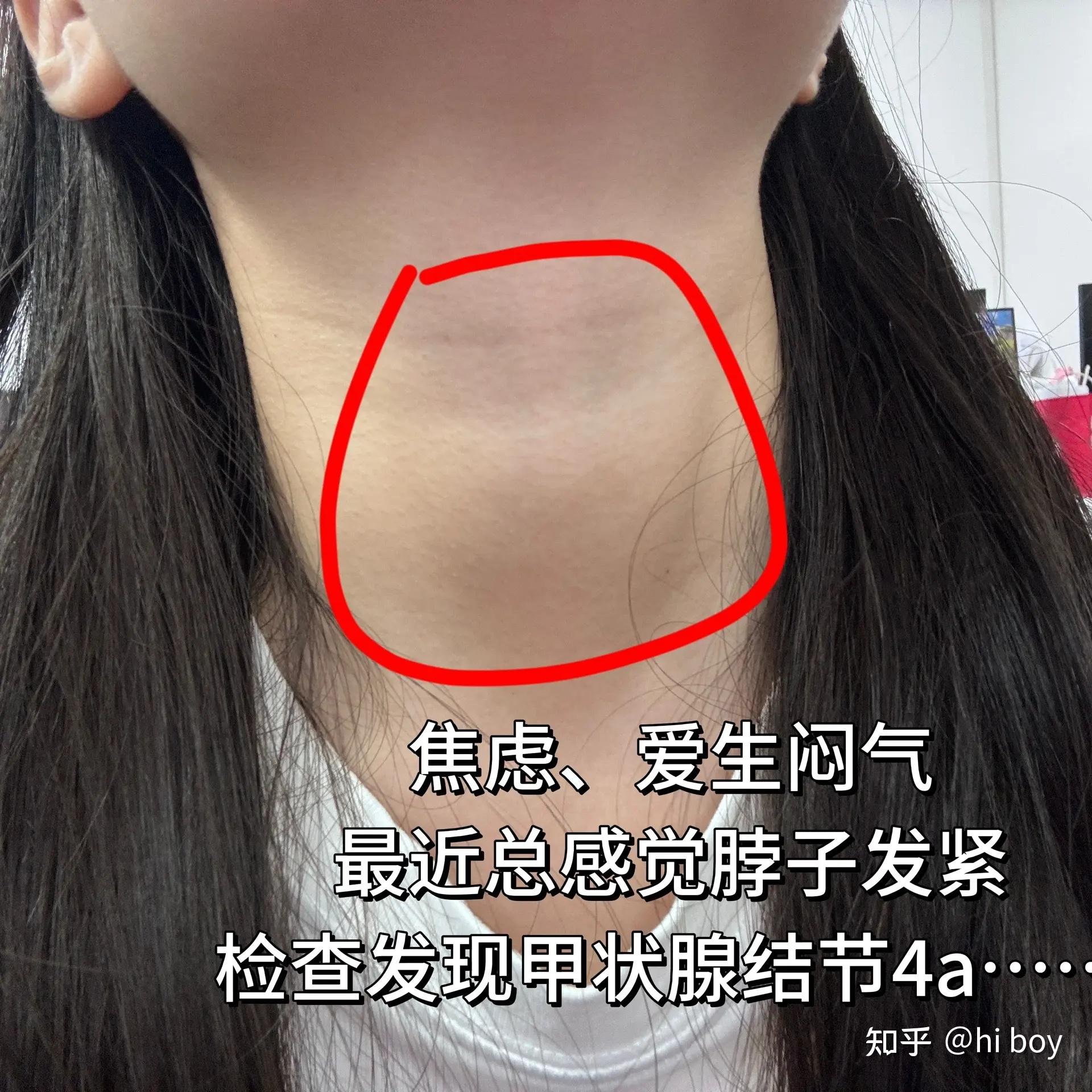 关于身体有结节可以吃蜂胶吗,甲状腺长囊肿能吃蜂胶吗的信息
