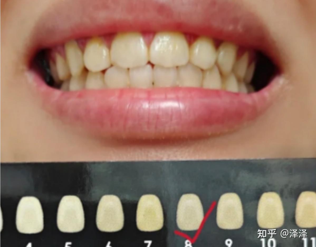 牙缝中间龋齿应该怎么处理呢？ - 知乎