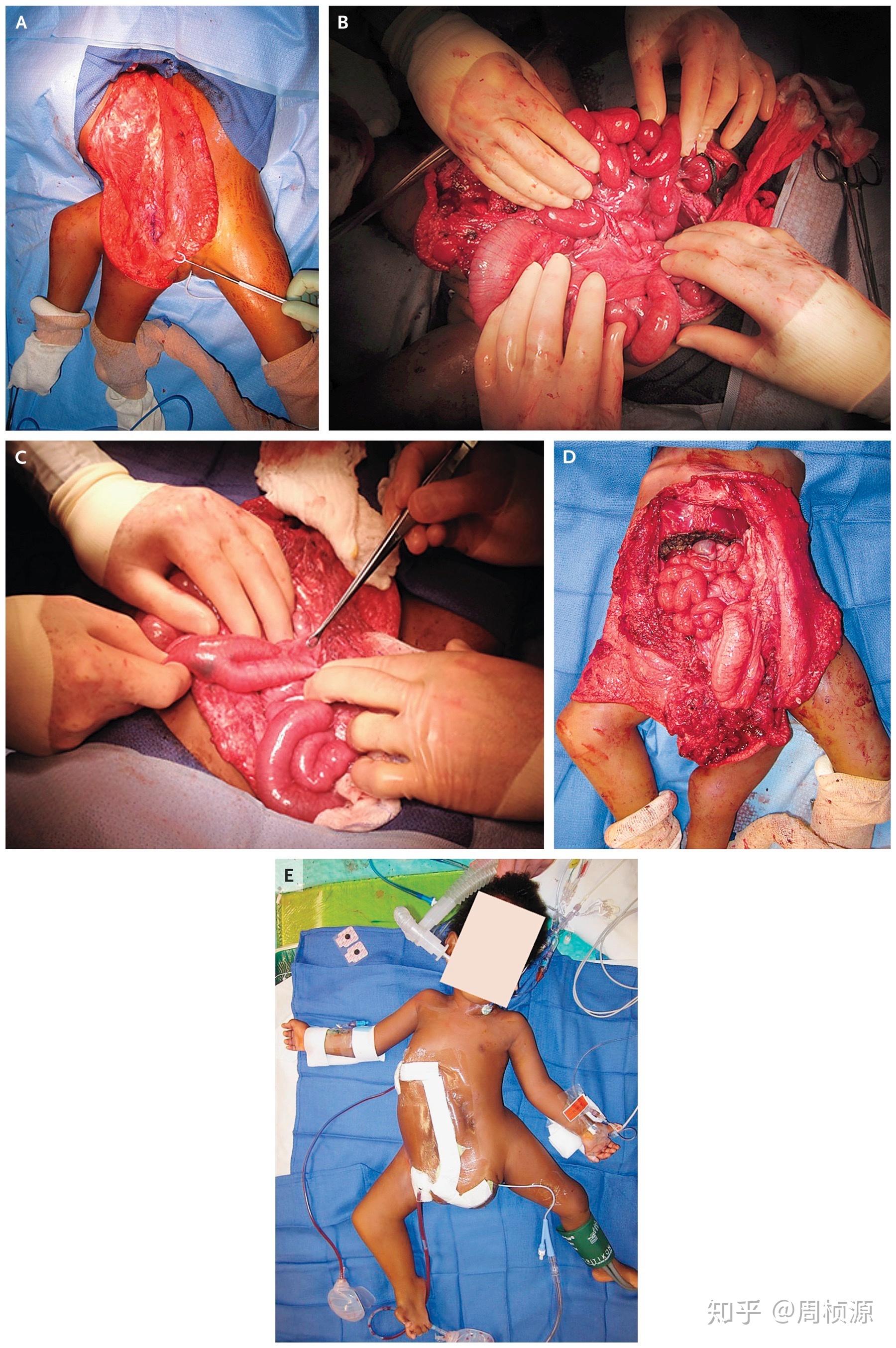 nejm 2017 case 33