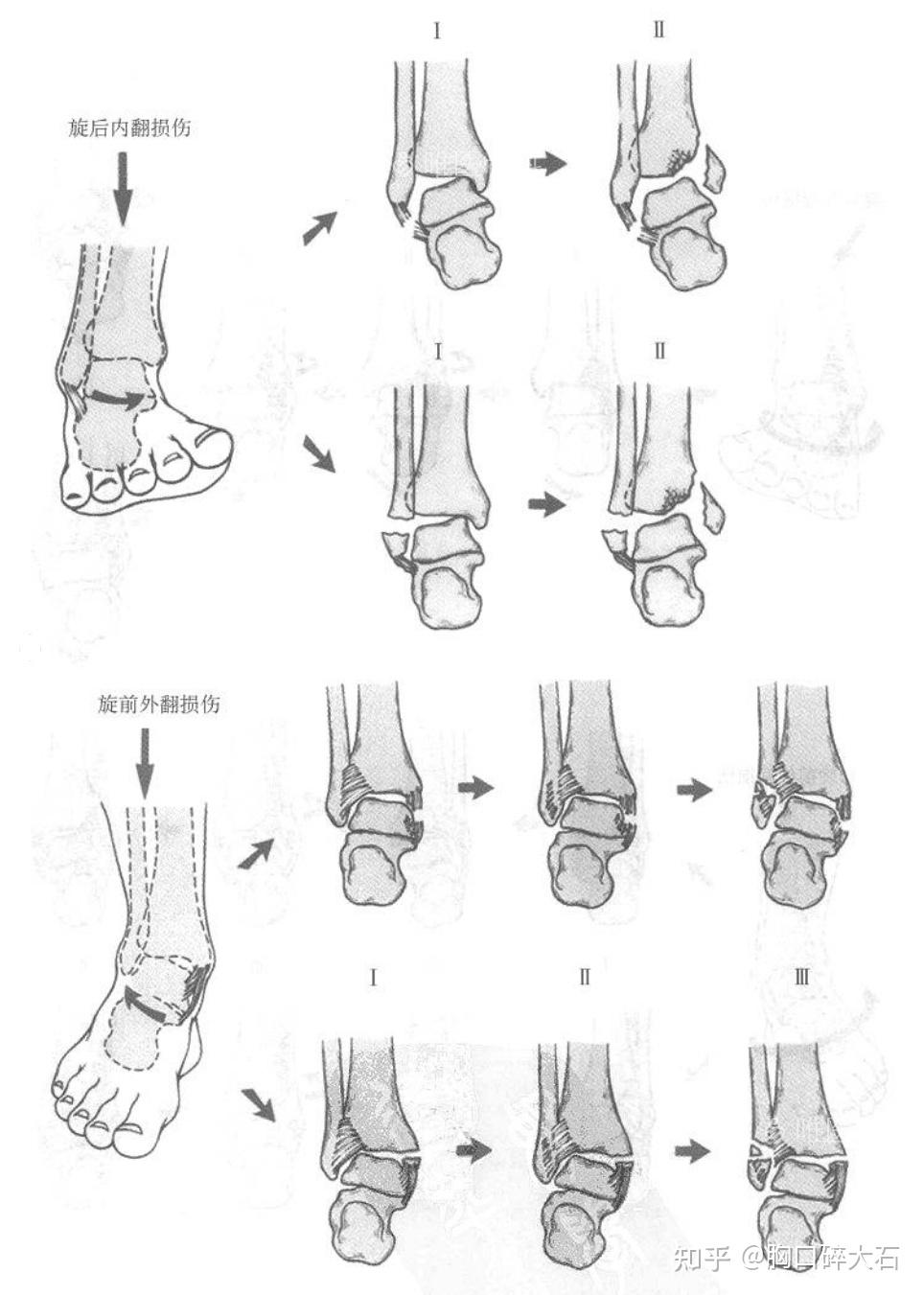 踝关节骨折分型图解图片