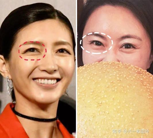 原本清晰的双眼皮线条已经被吃掉了,眼皮耷拉下垂,和江疏影的下垂情况