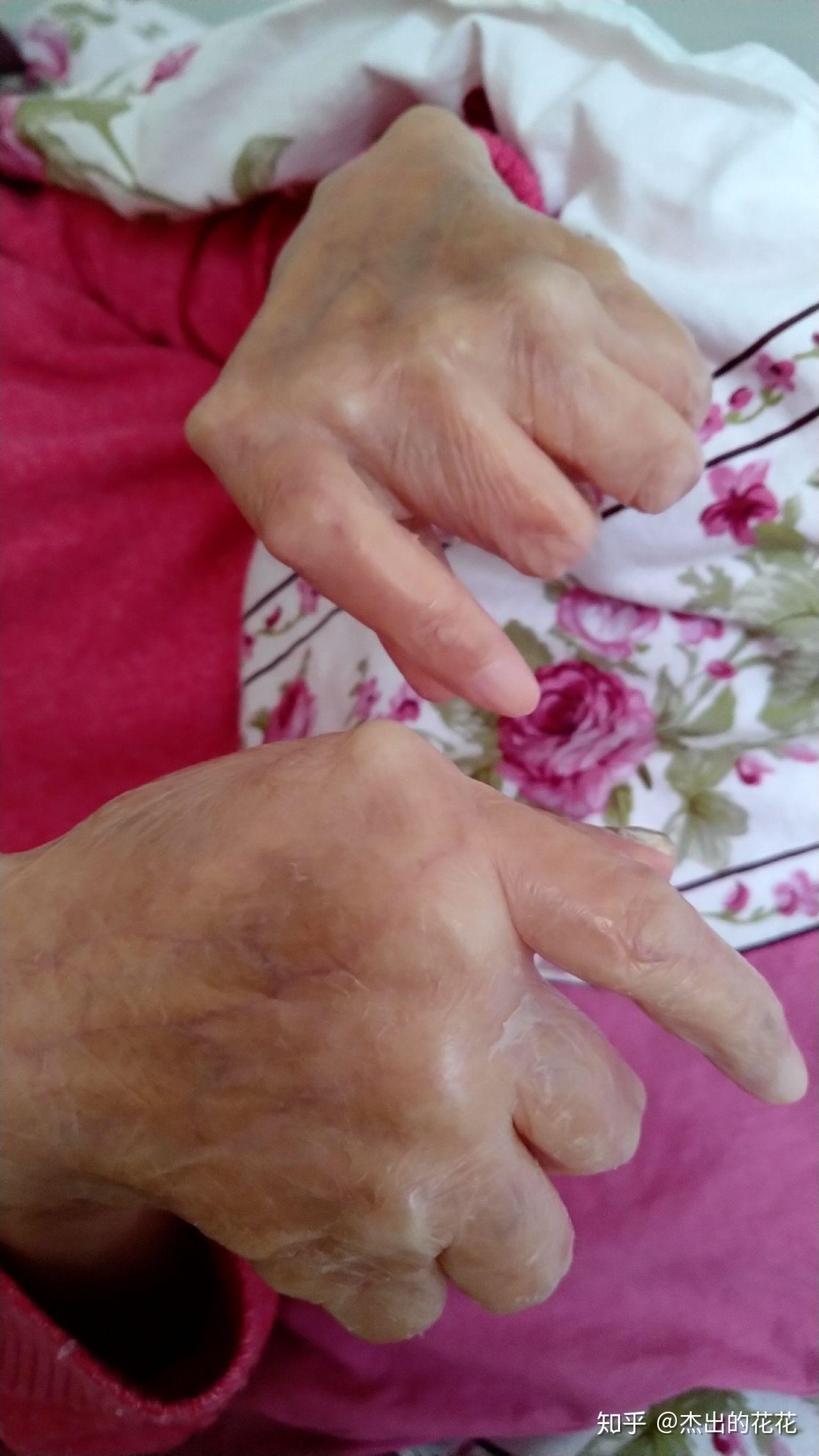 我的干燥综合症红斑狼疮康复治愈之路