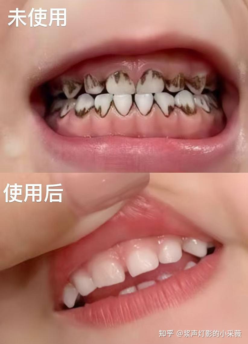 孩子牙齿黑成这样,根本不用多花钱!