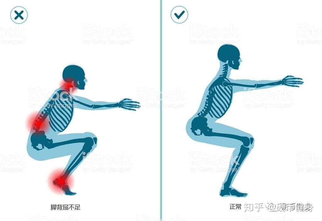 外八字扁平足问题踝关节内旋自检与改善方法