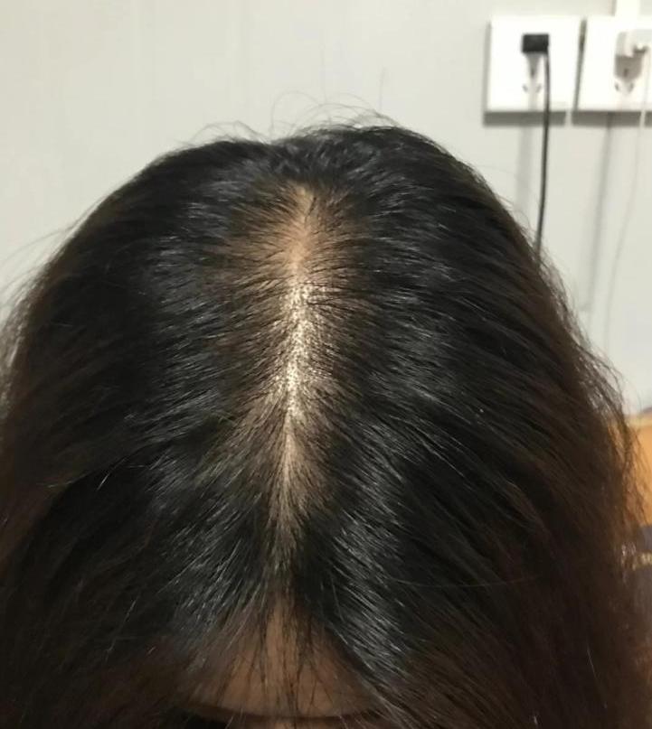 发量少的女生怎么才能增加发量? - 知乎