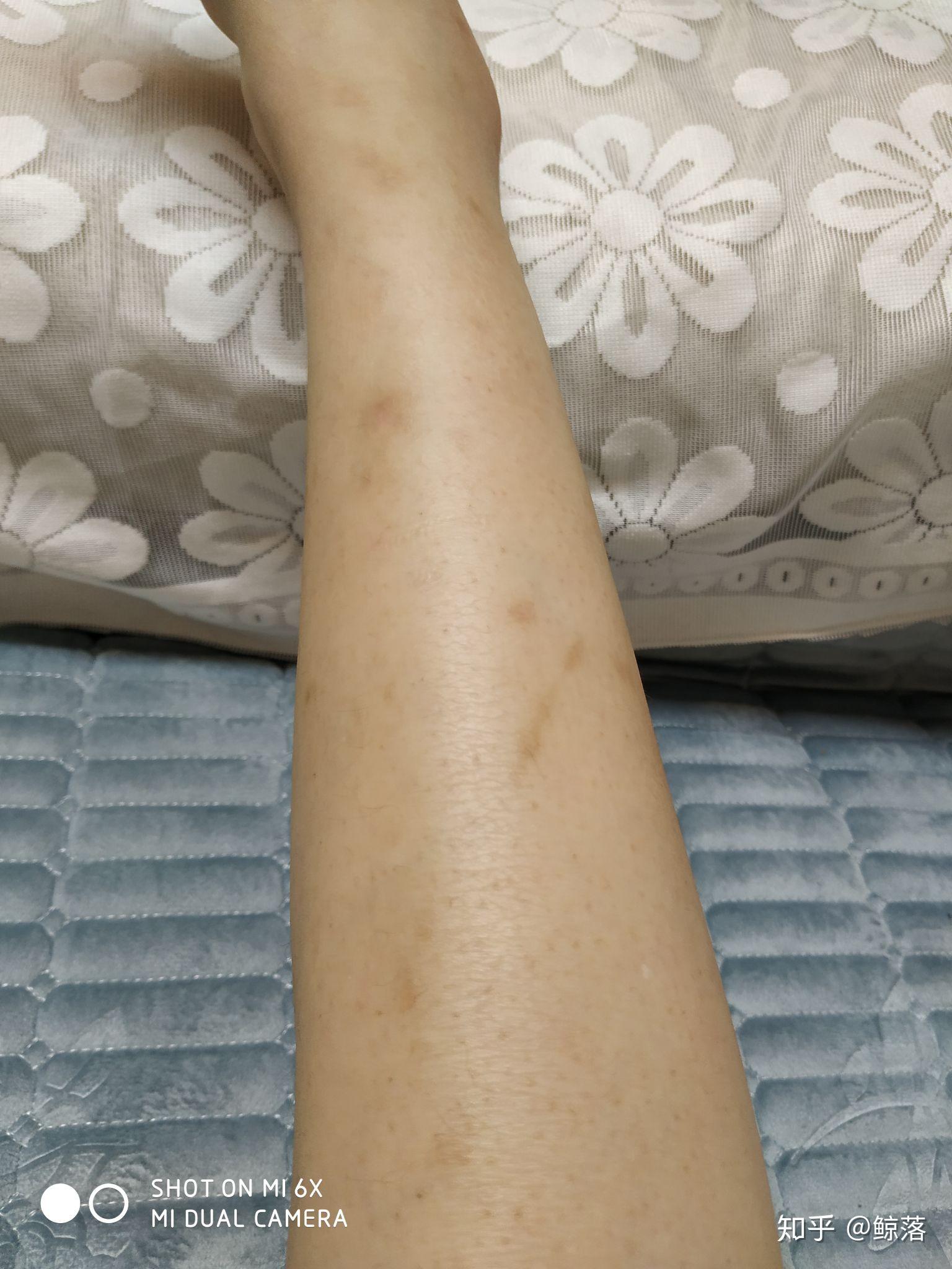 求黑色素淡化的办法