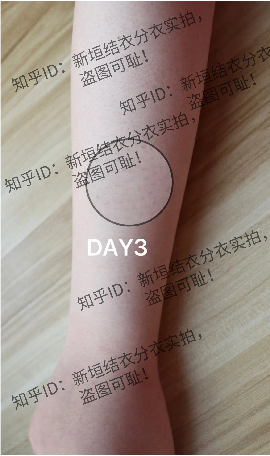 慕金脱毛仪用后有鸡皮肤(慕金脱毛仪鸡皮肤可以用吗) 慕金脱毛仪用后有鸡皮肤(慕金脱毛仪鸡皮肤可以用吗)