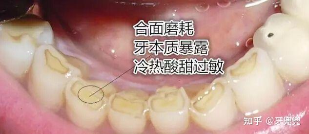 牙痛导致下颌骨消失三分之一? - 知乎