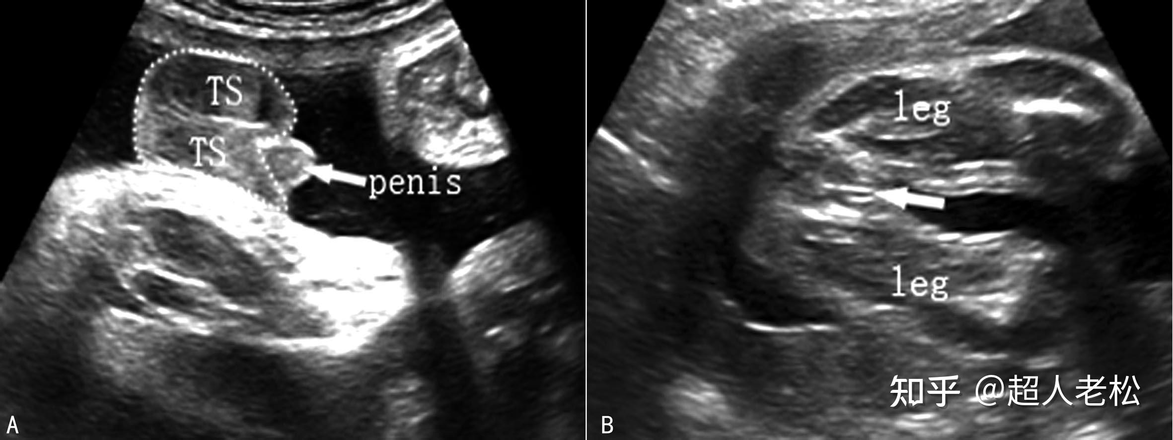 中晚期妊娠胎儿超声解剖特点 - 知乎