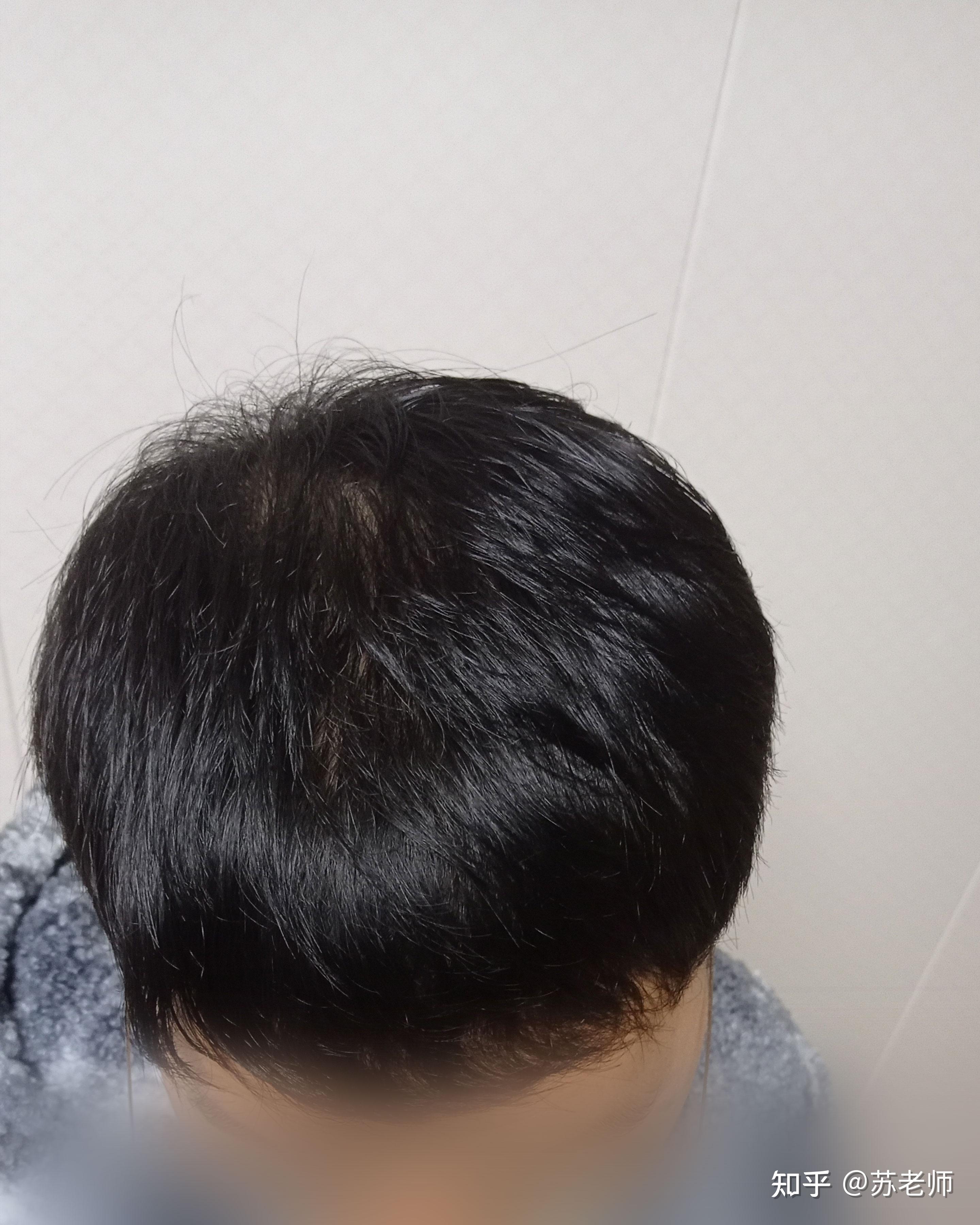 植发脱毛囊(植发的毛囊从哪里取的取完了就没有了吗)
