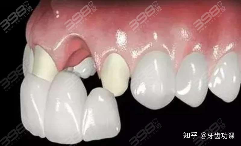 牙齿缺失5年了还能种吗?顺便了解下长期缺牙有什么危害 - 知乎