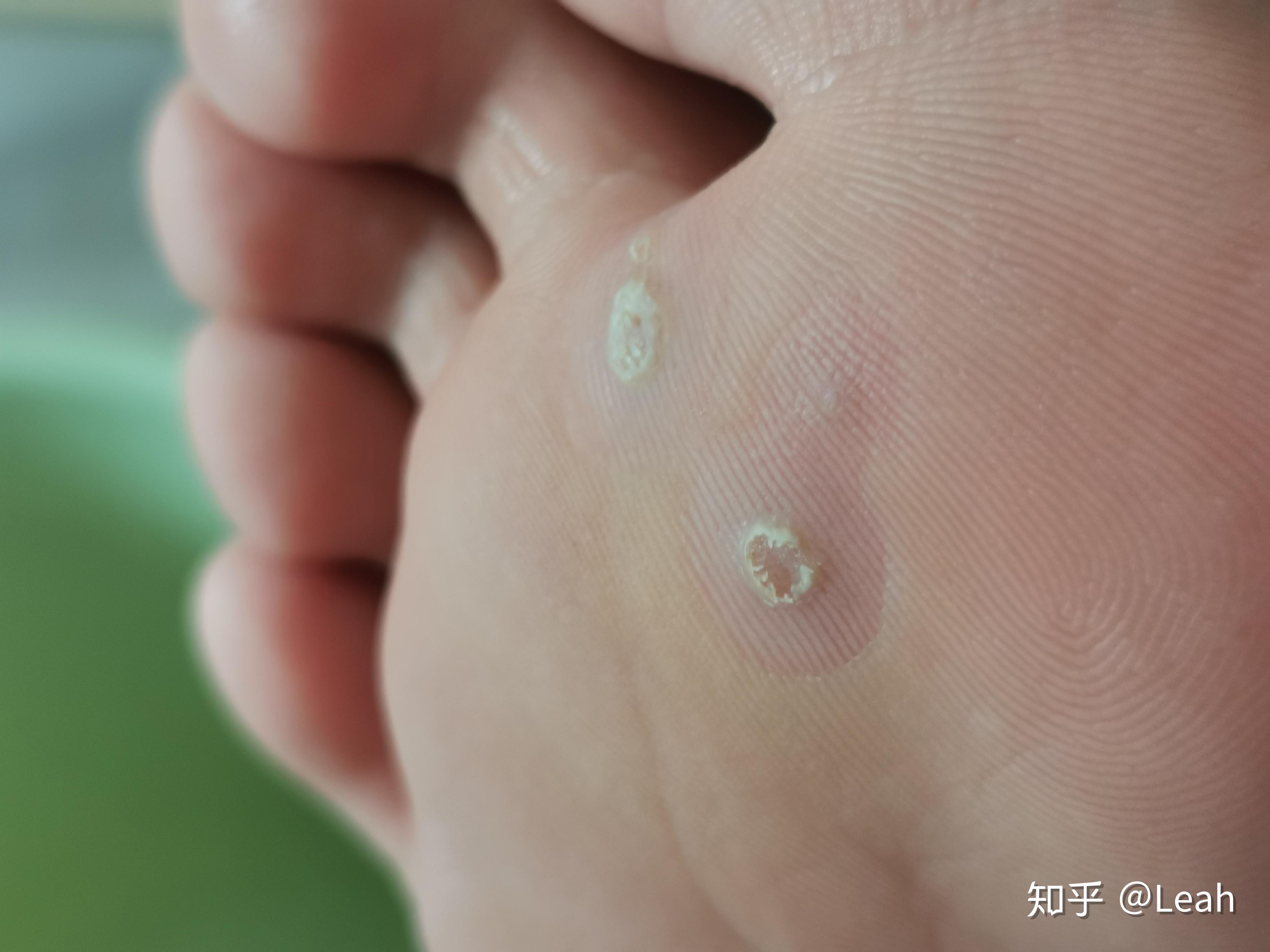 最近有小伙伴们问我斑蝥素乳膏的事,我总结了一下,像我去年涂的没有