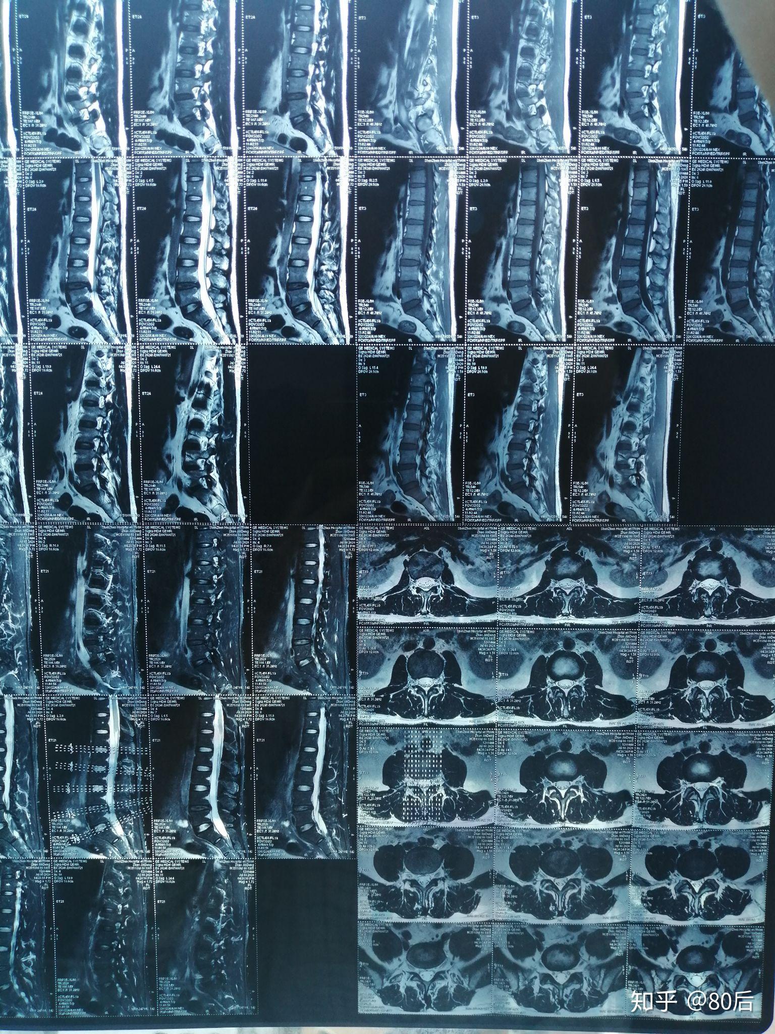 腰椎间盘脱出治疗