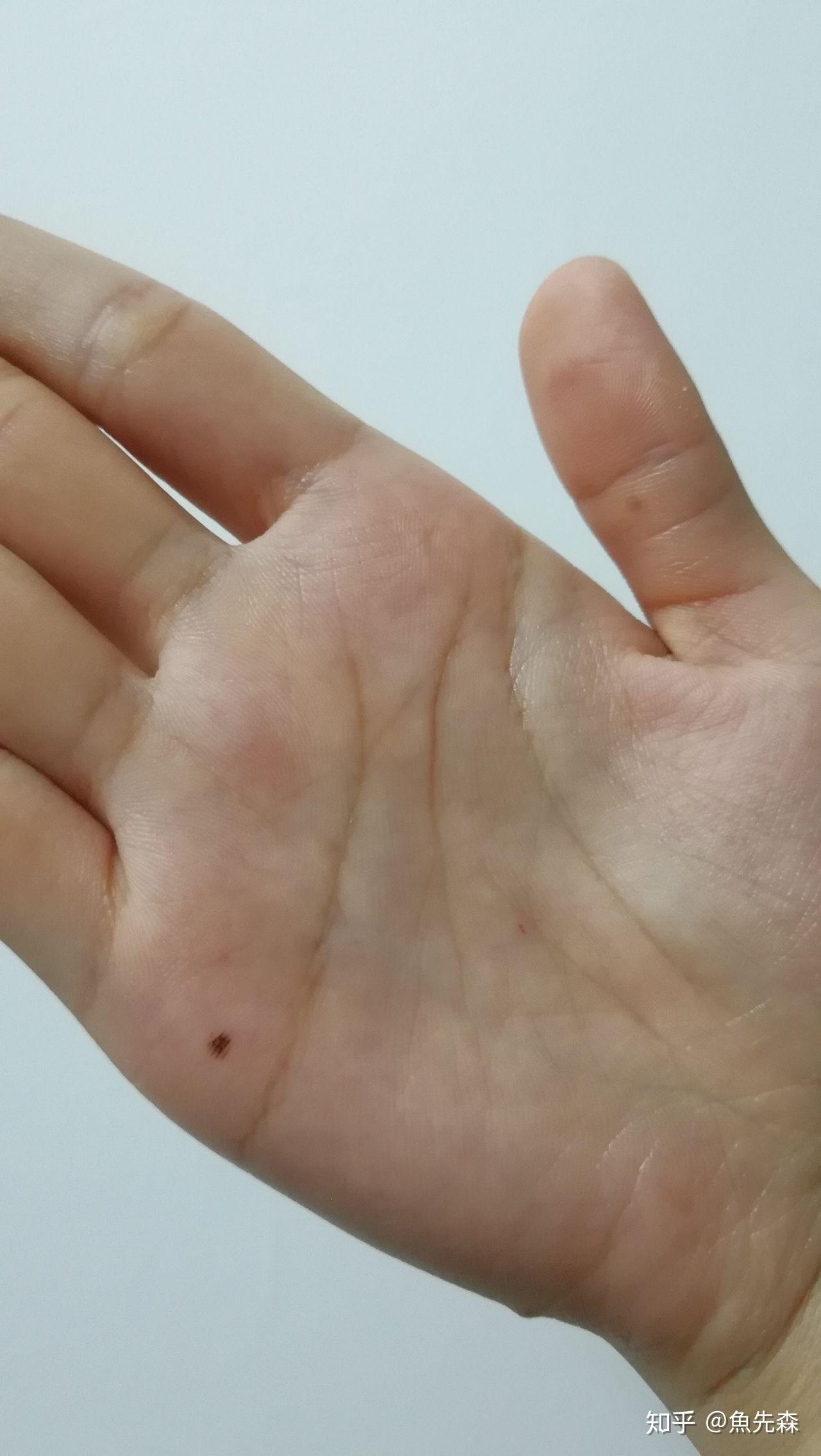 掌心有痣是什么体验