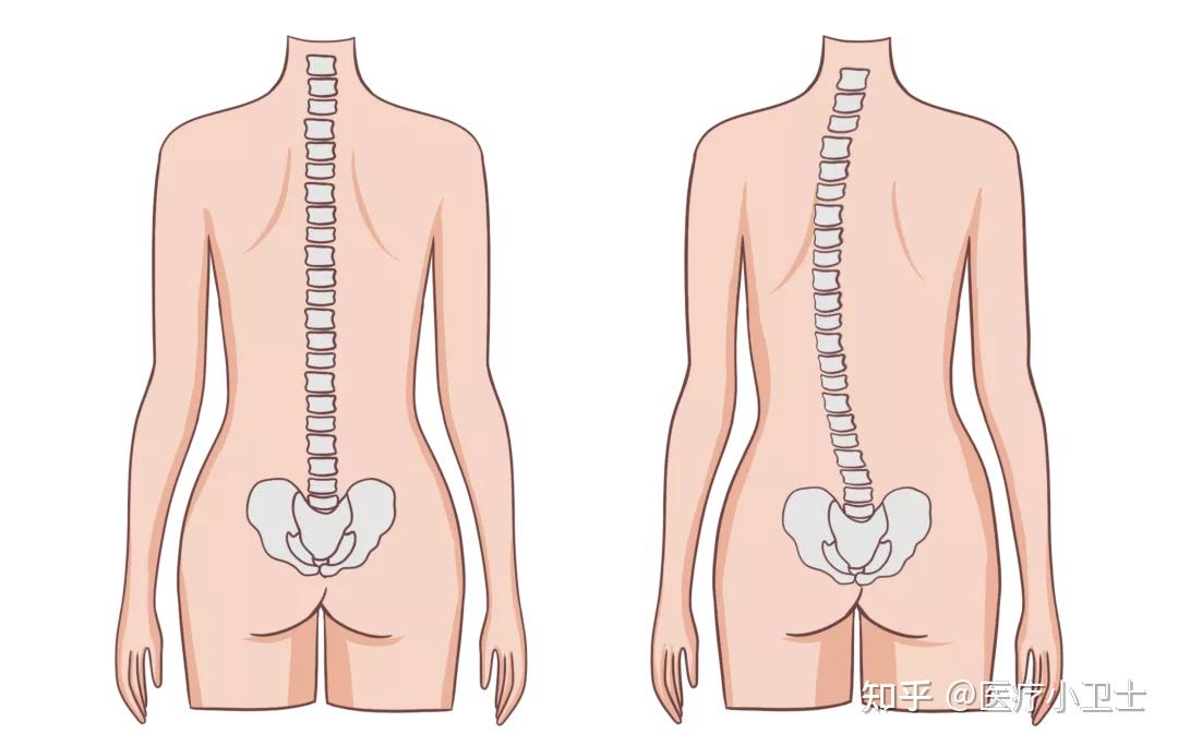 要知道脊柱側彎不僅影響體形更重要的是會導致嚴重的身體健康問題脊柱
