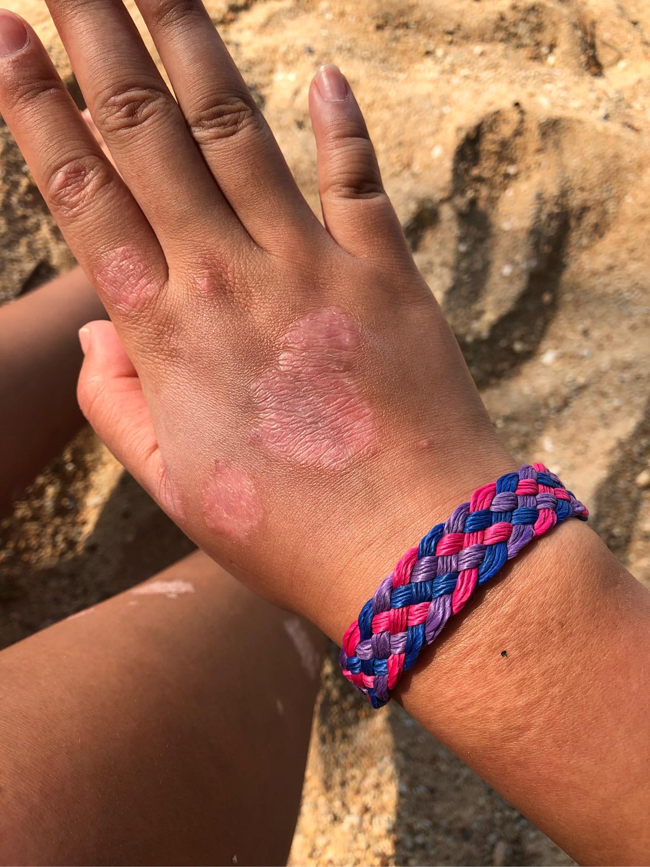 银屑病牛皮癣晒太阳自愈过程记录