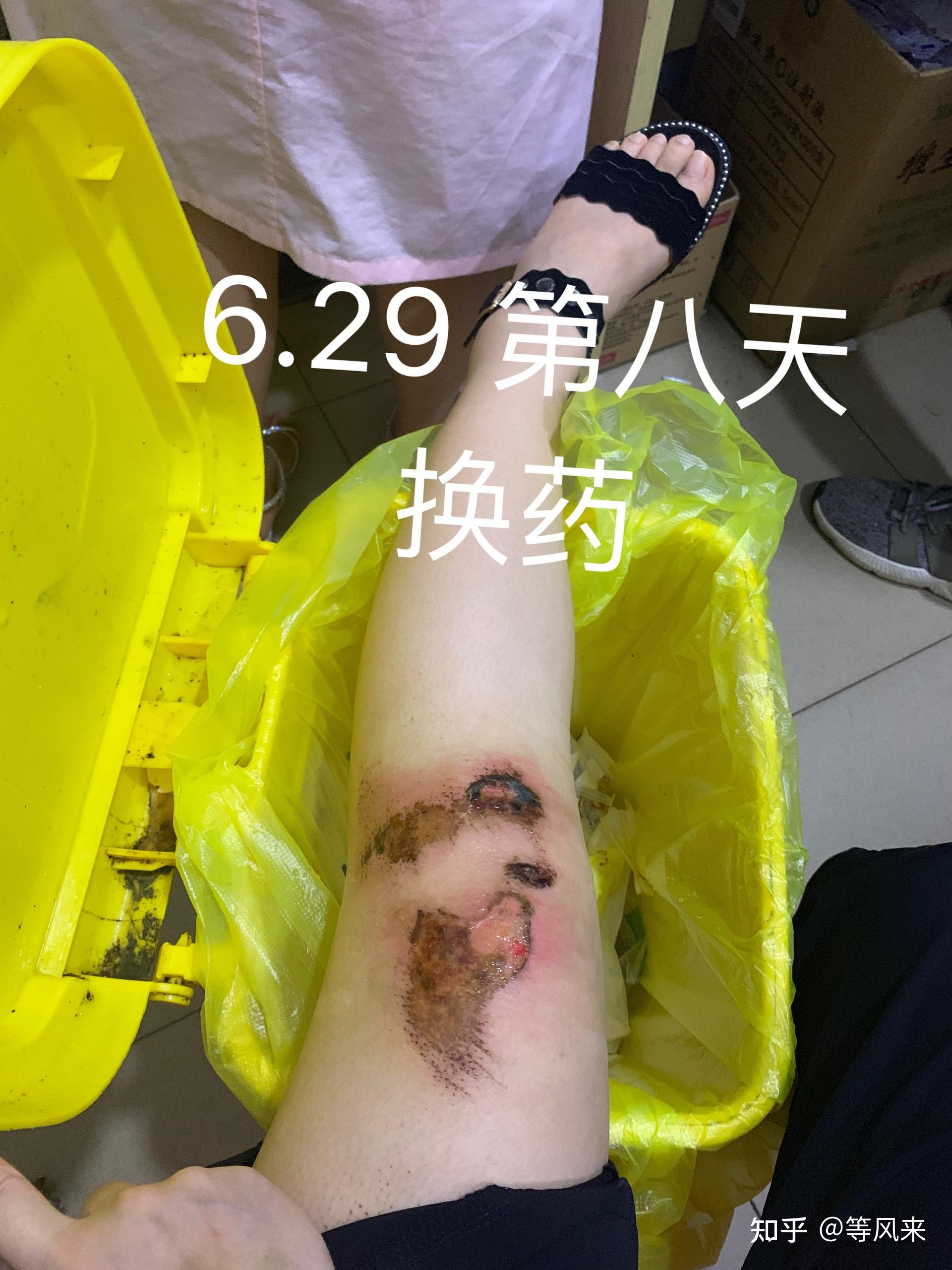 开一个膝盖腿伤恢复记录帖