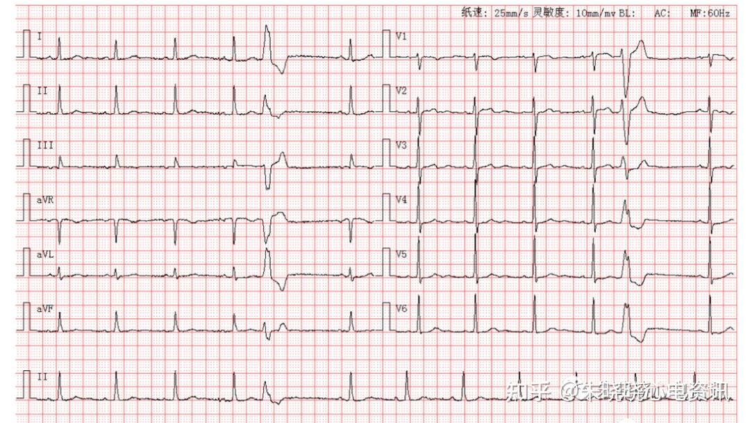 患者女,60岁,图为其术前体检心电图第1323期读图解析专注心电技术和