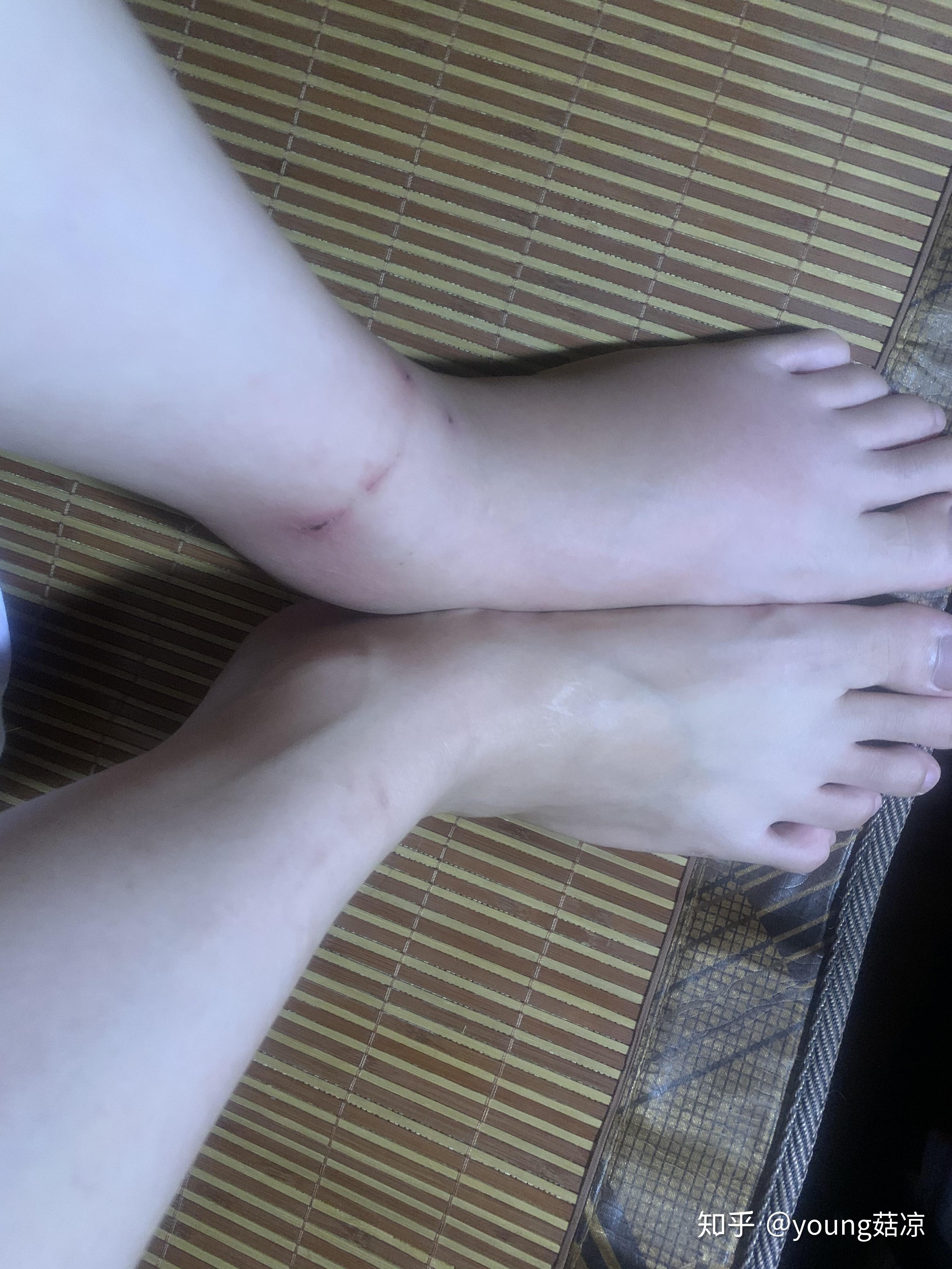 被自家猫咬了,肿了一周,它有多委屈? - 知乎