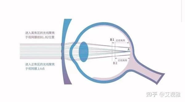 【专业知识】:瞳高对配镜的影响 - 知乎