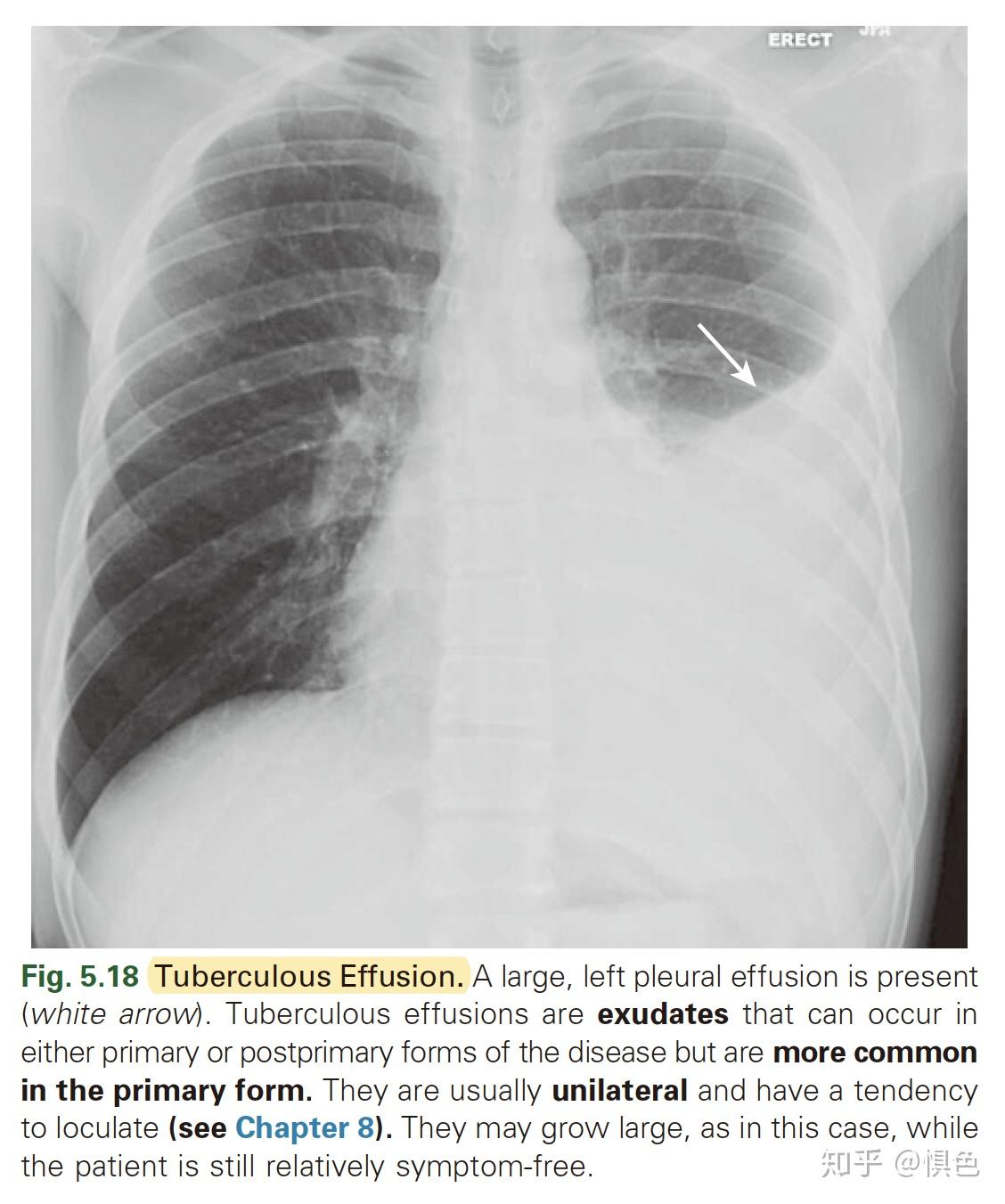 肺结核-医学影像学-笔记 - 知乎